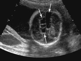 F igure 15-15, Porencephaly. Oblique image of the fetal head shows multiple cystic spaces (arrows) due to porencephaly.