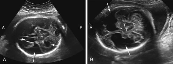 F igure 15-16, Schizencephaly. A, Unilateral. Axial image of the fetal head shows a fluid-filled cleft in the brain parenchyma (long arrow) extending from the lateral ventricle (short arrows) to the brain surface. B, Bilateral. Axial image of the head of a different fetus depicts bilateral, fluid-filled clefts (arrows) in the brain. A, Anterior; P, posterior; T, thalami.