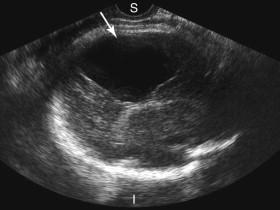 F igure 15-17, Arachnoid cyst. Oblique image of the fetal head demonstrates a large cystic structure in the parietal region corresponding to an arachnoid cyst (arrow) . I, Inferior; S, superior.