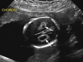 F igure 15-18, Choroid plexus cysts. Axial image of the fetal head reveals bilateral choroid plexus cysts (arrows) .