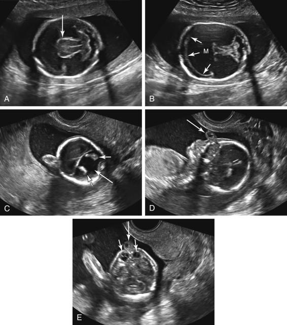 F igure 15-19, Alobar holoprosencephaly. Ultrasound images in two fetuses with alobar holoprosencephaly. A and B, Transabdominal images in a fetus at 20 weeks gestation. A, Fused thalami (arrow). B, Monoventricle (M) with the anterior rim of brain tissue in boomerang configuration (short arrows). C to E, Transvaginal images of a different fetus at 18 weeks gestation. C, Monoventricle (long arrow) containing bilateral choroid plexus (short arrows). D, Proboscis (arrow) is demonstrated on midline sagittal profile view. E, Hypotelorism (short arrows) and proboscis (long arrow) are depicted on axial view of the head at the level of the orbits.