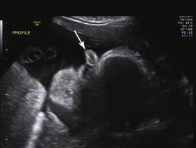 e -F igure 15-1, Profile ( e-Fig. 15-1 ) and axial views ( e-Fig. 15-2 ) of fetal face show a proboscis (long arrows) and severe hypotelorism with no significant space between the orbits ( short arrows [ e-Fig. 15-2 ]). See also Videos 15-1 and 15-2 .