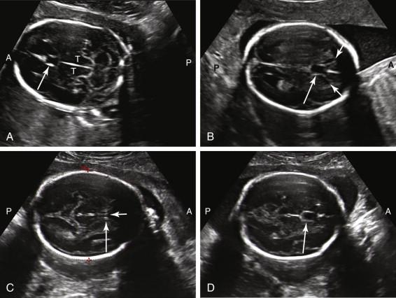 F igure 15-2, Cavum septi pellucidi. A and B, Axial images of the head in two different fetuses depict cavum septi pellucidi as a rectangular, anechoic structure (long arrow) anterior to the thalami (T, image A ) between the frontal horns of lateral ventricles ( short arrows , image B ). C and D, Columns of the fornix versus cavum septi pellucidi. C, Columns of the fornix. Axial image of the fetal head demonstrates a central linear echo (short arrow) in a structure that otherwise resembles the cavum septi pellucidi (long arrow) . This structure corresponds to the columns of the fornix and should not be mistaken for the cavum septi pellucidi. D, Cavum septi pellucidi. Axial image of the fetal head after slight adjustment of the scan plane in image C demonstrates cavum septi pellucidi (long arrow). Note the absence of a central linear echo. A, Anterior; P, posterior.