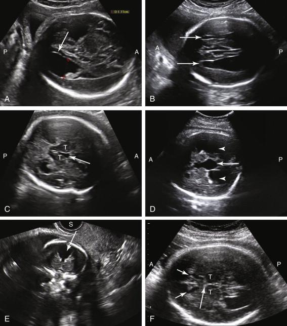 F igure 15-20, Agenesis of the corpus callosum. Ultrasound features in different fetuses. A, Colpocephaly. Axial image of the fetal head shows dilated lateral ventricle measuring 1.77 cm (red cursors) with teardrop configuration and disproportionate enlargement of the occipital horn (long arrow) compared with remainder of the lateral ventricle. B, Parallel ventricles. Axial image of the fetal head shows teardrop-shaped dilated lateral ventricles (arrows) with a relatively parallel course. C, Dilated third ventricle. Axial image of the fetal head demonstrates mildly dilated third ventricle (arrow) between the thalami (T). D, Superior extension of the third ventricle. Axial image of the fetal head at the level of the lateral ventricles (arrowheads) shows superior extension of dilated third ventricle (arrow) . E, Interhemispheric cyst. Coronal image depicts interhemispheric cyst (arrow) as a focal fluid collection extending between the cerebral hemispheres in the superior portion of the head. F, Absent cavum septi pellucidi. Axial image of the fetal head shows nonvisualization of cavum septi pellucidi in expected location (long arrow) anterior to the thalami (T) and posterior to the frontal horns of the lateral ventricles (short arrows) . A, Anterior; I, inferior; P, posterior; S, superior.