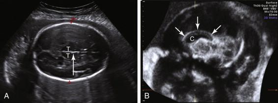 F igure 15-3, A, Third ventricle. Axial image of the fetal head demonstrates normal third ventricle as a slitlike structure (arrow) between the thalami (T). B, Corpus callosum. Midline sagittal image of the fetal head obtained using three-dimensional reconstruction demonstrates corpus callosum (arrows) superior to the cavum septi pellucidi (C).