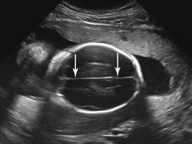 F igure 15-4, Falx cerebri. Axial image of the fetal head demonstrates falx cerebri (arrows) as a midline, linear, echogenic structure extending between the cerebral hemispheres.