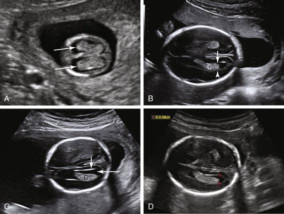 F igure 15-5, Lateral ventricles: normal. A, First trimester. Axial image of the head at the level of the lateral ventricles at 12 weeks gestation demonstrates bilateral choroid plexus filling the majority of the head (arrows). B and C, Second trimester: Normal variation in filling of the atrium of the lateral ventricle by the choroid plexus. B, Choroid plexus (C) fills the entire width of the lateral ventricle, abutting both the medial (short arrow) and the lateral (arrowhead) ventricular walls. C, Incomplete filling of the ventricle, with a small amount of fluid (long arrow) between the medial wall of the ventricle (short arrow) and medial surface of the choroid plexus (C). This is considered normal when the lateral ventricle is normal in size. The choroid plexus typically fills at least 60% of the width of the normal lateral ventricle. D, Lateral ventricle: measurement. Axial image of the fetal head during the second trimester demonstrates the technique for measuring the lateral ventricles. The width of the atrium of the ventricle is measured near the posterior aspect of the choroid plexus (red cursors). The measurement of 5.8 mm is normal (upper limit of normal = 10 mm).