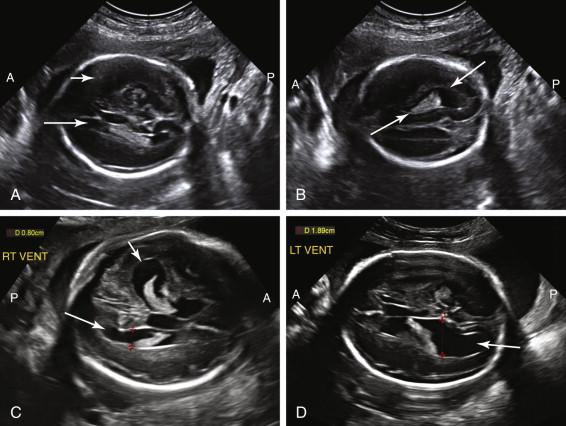 F igure 15-6, Near-field artifact: effect on visualization of lateral ventricles. A, Axial image of the fetal head shows far-field lateral ventricle (long arrow) in a conventional measurement scan plane. Near-field lateral ventricle is poorly seen due to near-field reverberation artifact (short arrow) . B, Oblique image of the head in the same fetus as in image A better depicts the near-field lateral ventricle (arrows) , although the ventricle is not seen in the optimal scan plane for measurement. C, Axial image of the head in a different fetus shows both lateral ventricles. The right lateral ventricle (long arrow) is in the far field in the appropriate scan plane for measurement, and is normal in size at 0.8 cm. The left lateral ventricle (short arrow) is in the near field and appears large, but is not in the optimal scan plane for measurement. D, Axial image of the head of the same fetus as in image C , obtained after the fetus rolled into a different position, depicts the left lateral ventricle (arrow) in the far field, in an improved scan plane for measurement. The measurement of 1.89 cm (red cursors) confirms the ventricle is dilated. A, Anterior; P, posterior.