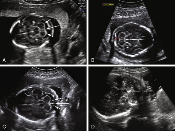 F igure 15-7, Posterior fossa: normal anatomy in different fetuses. A, Cerebellum. Axial image of the head, tilted inferiorly toward the occiput depicts cerebellum, composed of two rounded hemispheres laterally (short arrows) and the vermis (long arrow) in the midline. B, Cisterna magna: measurement. Axial image of the head demonstrates measurement of the cisterna magna from the posterior margin of the cerebellar vermis to the inside of the occipital bone (red cursors) . The measurement of 0.36 cm is normal (normal range is between 0.2 and 1.0 cm). C, Cisterna magna: septa. Axial image of the head depicts normal linear septa in the cisterna magna, extending from midline (long arrow) and from junction between the vermis and the cerebellar hemisphere on each side (short arrows) posteriorly to the occipital bone. D, Fourth ventricle. Oblique image of the fetal head shows the fourth ventricle (arrow) in the anterior portion of the posterior fossa.