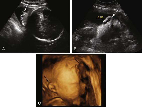 F igure 15-8, A, Hair. Image of the fetal head during the third trimester shows prominent hair (arrow) extending into the amniotic fluid from the head. B and C, Ear. Gray-scale (B) and three-dimensional, surface-rendered (C) images in the region of the fetal head show ear (arrows) extending from the fetal head.