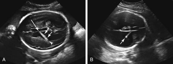 F igure 15-9, Dilated lateral ventricle: choroid plexus. A, Dangling choroid plexus. Axial image of the fetal head demonstrates the anterior portion of the choroid plexus along the medial wall of the lateral ventricle (long arrow) with remainder of the choroid plexus (short arrows) dangling toward the lateral wall of the ventricle (arrowhead) . The choroid plexus is also diminutive in size. B, Diminutive choroid plexus. Axial image of the fetal head shows markedly diminutive choroid plexus (arrow) in enlarged lateral ventricle.
