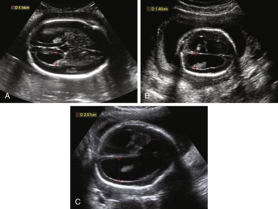 F igure 15-10, Ventriculomegaly: severity. Axial images of the head in three different fetuses show mild ventriculomegaly with atrial width of 1.14 cm (A), moderate ventriculomegaly with atrial width of 1.4 cm (B), and severe ventriculomegaly (C) with atrial width of 2.57 cm. Red cursors, Walls of the lateral ventricle.