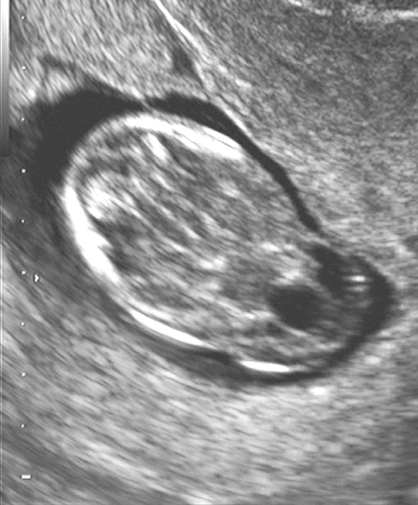 Figure 20.1, Cephalocele: axial view.