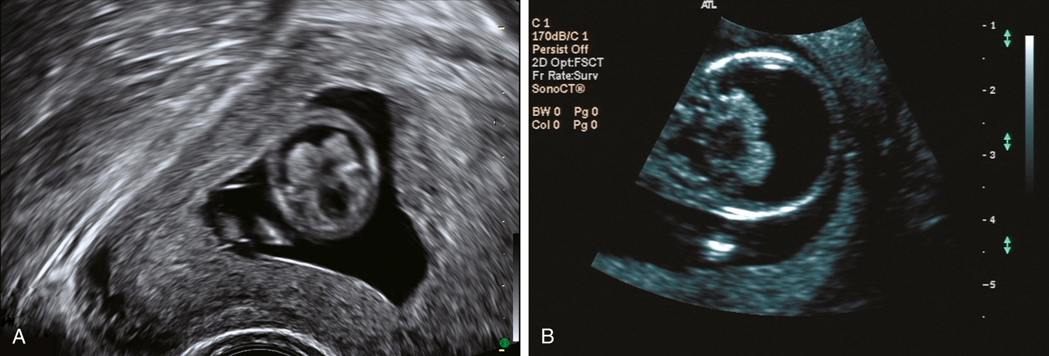 Figure 20.11, Holoprosencephaly: axial view.