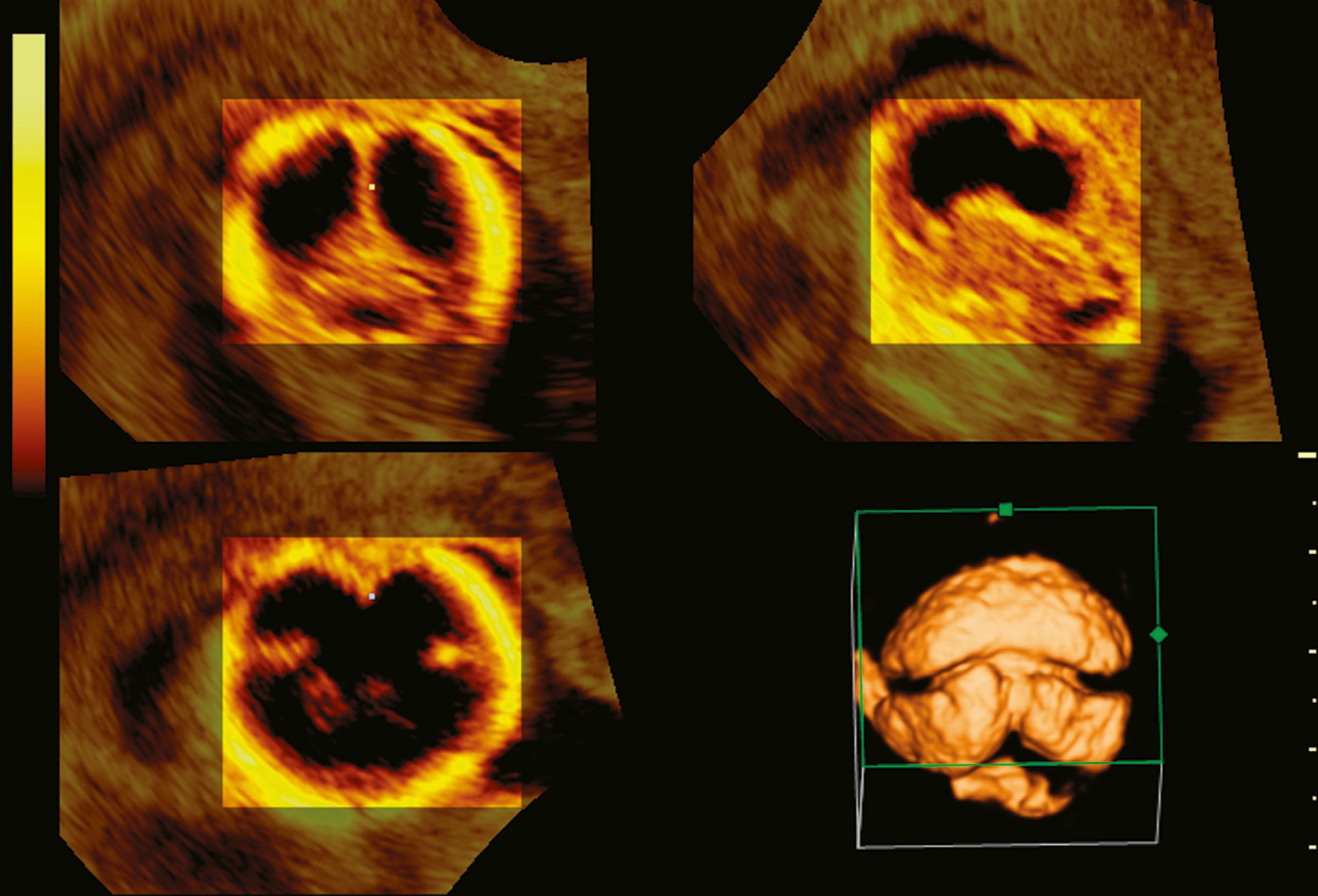 Figure 20.13, Semilobar holoprosencephaly.