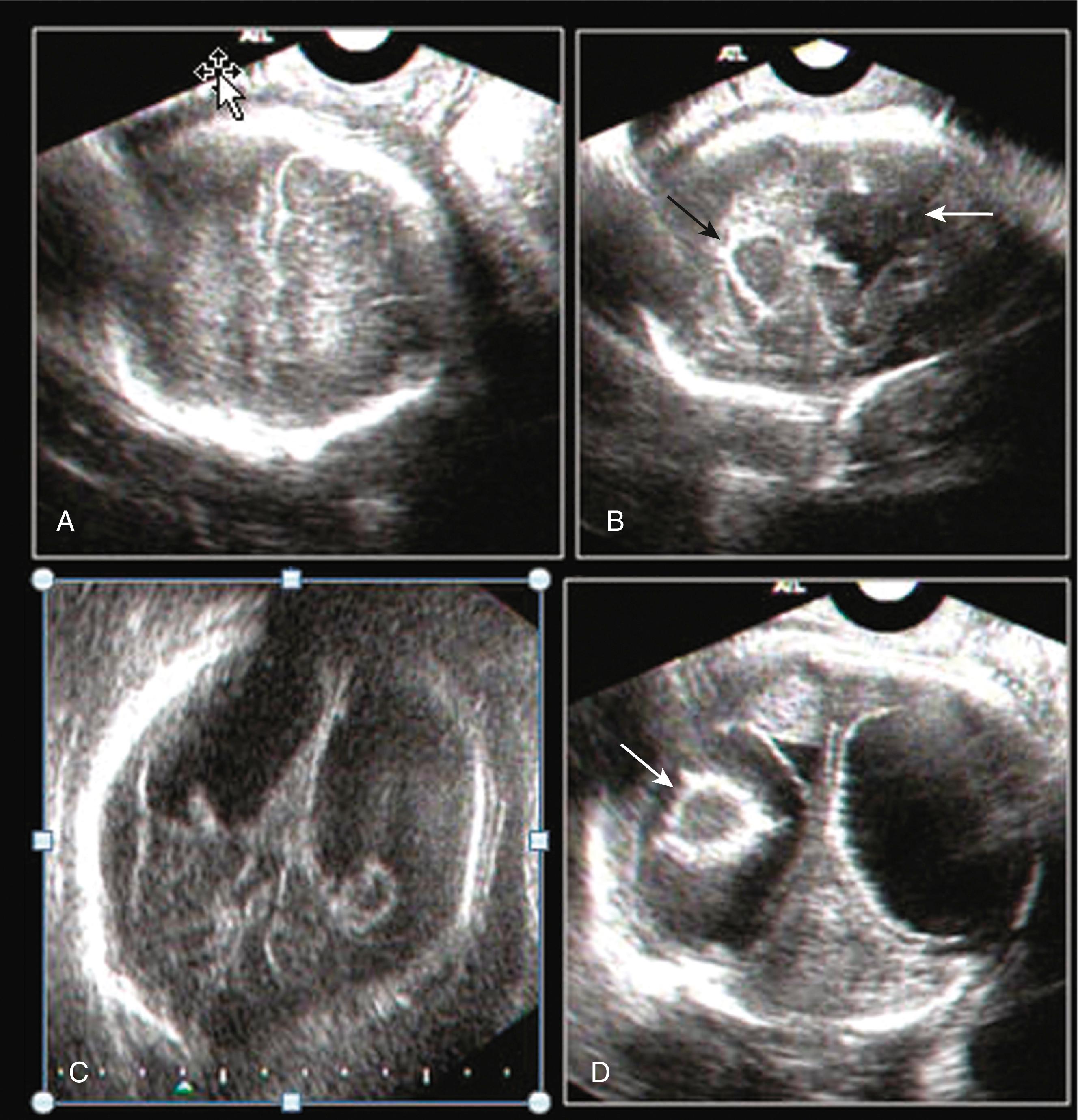 Figure 20.15, Porencephalic cyst: coronal view.