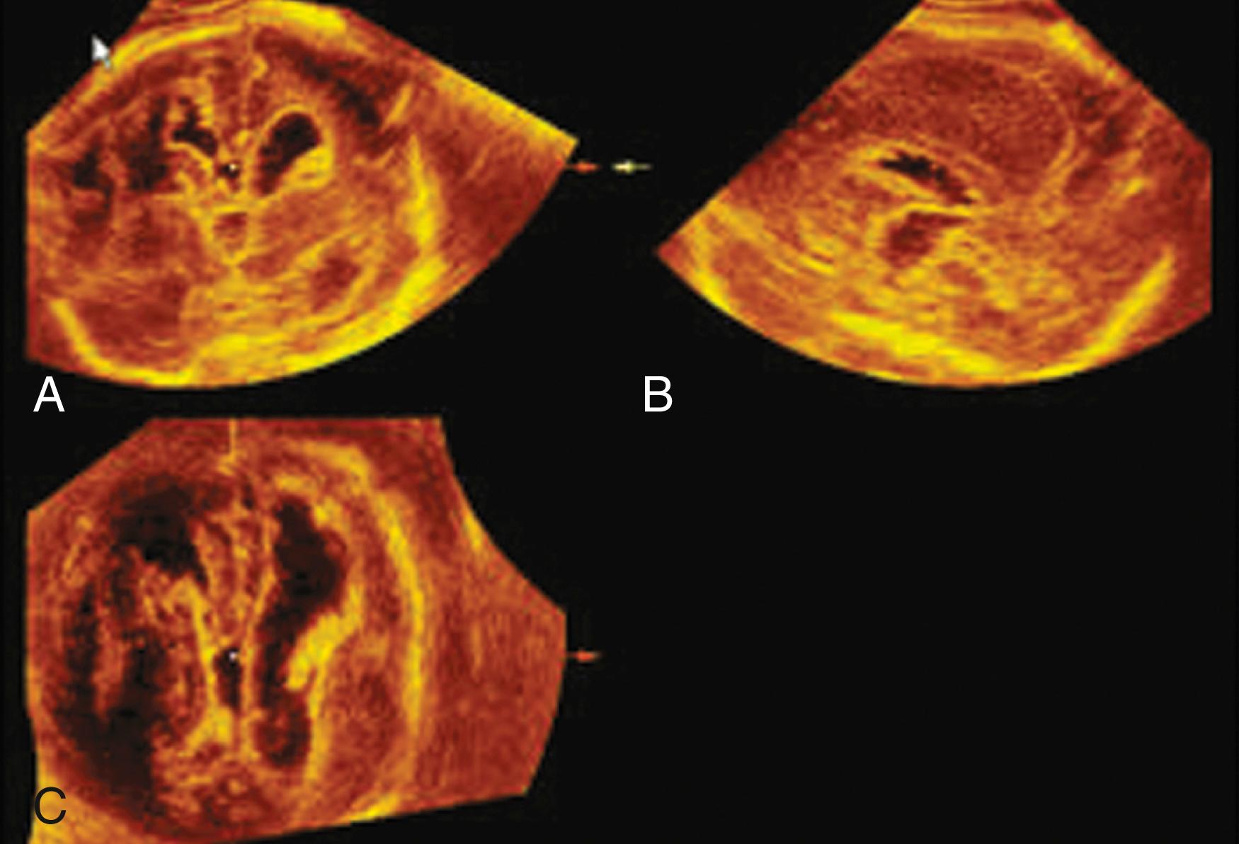 Figure 20.16, Image of brain with porencephalic cyst: 3D orthogonal view.