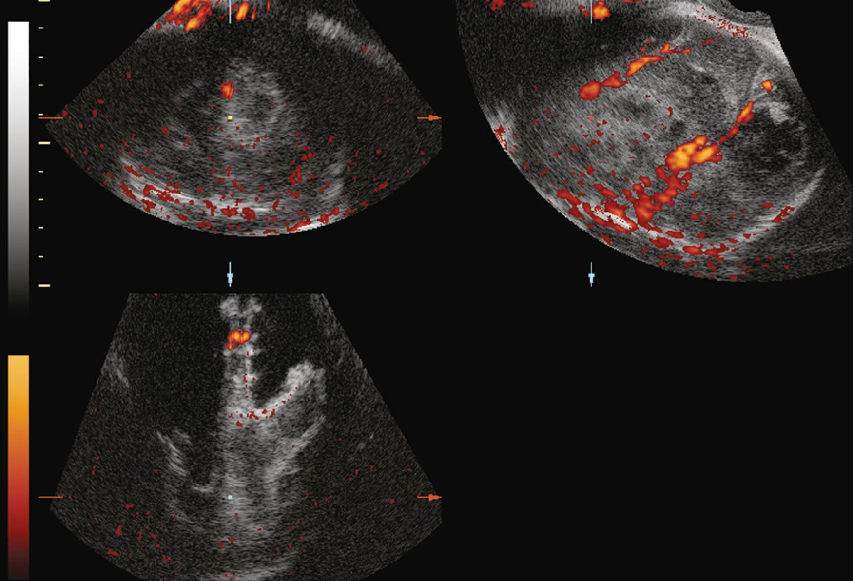 Figure 20.17, Porencephalic cyst: 3D color Doppler angiogram.