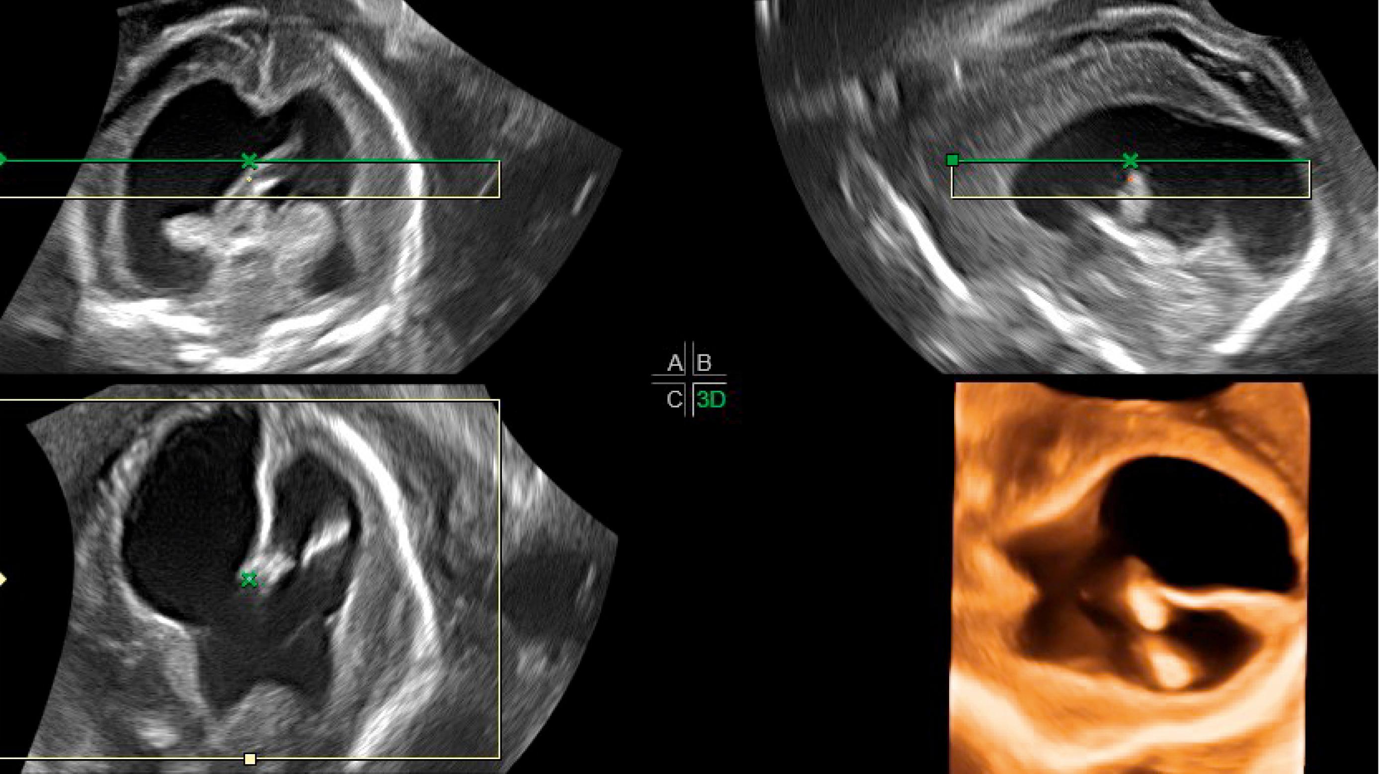 Figure 20.20, Aqueductal stenosis: 3D view.