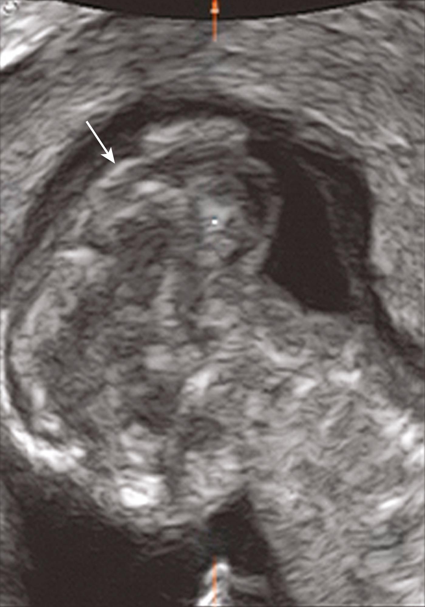 Figure 20.2, Cephalocele: sagittal view.