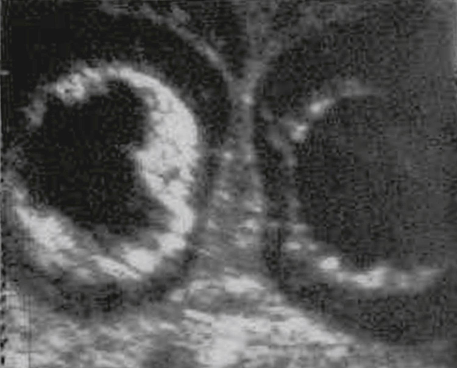 Figure 20.21, Aqueductal stenosis: coronal view of posterior horns.