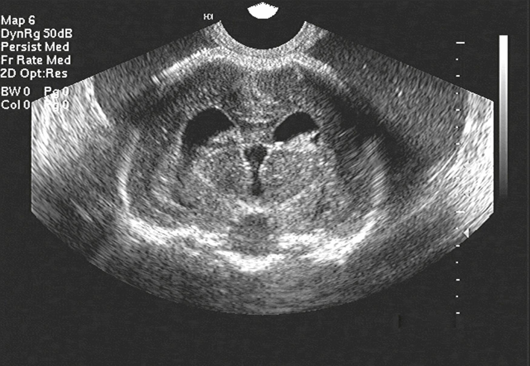 Figure 20.22, Aqueductal stenosis: coronal view.