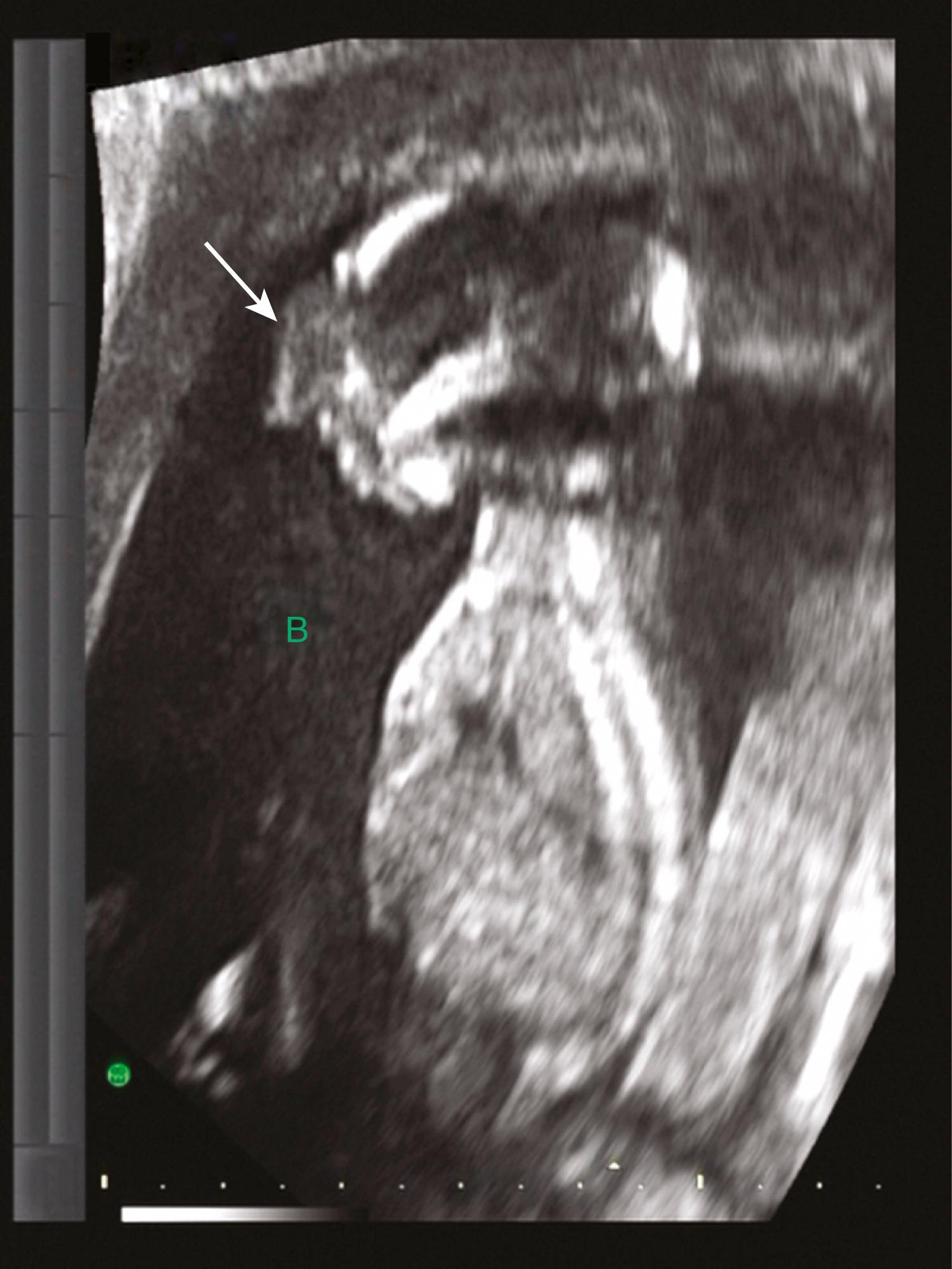 Figure 20.4, Cephalocele: sagittal view.