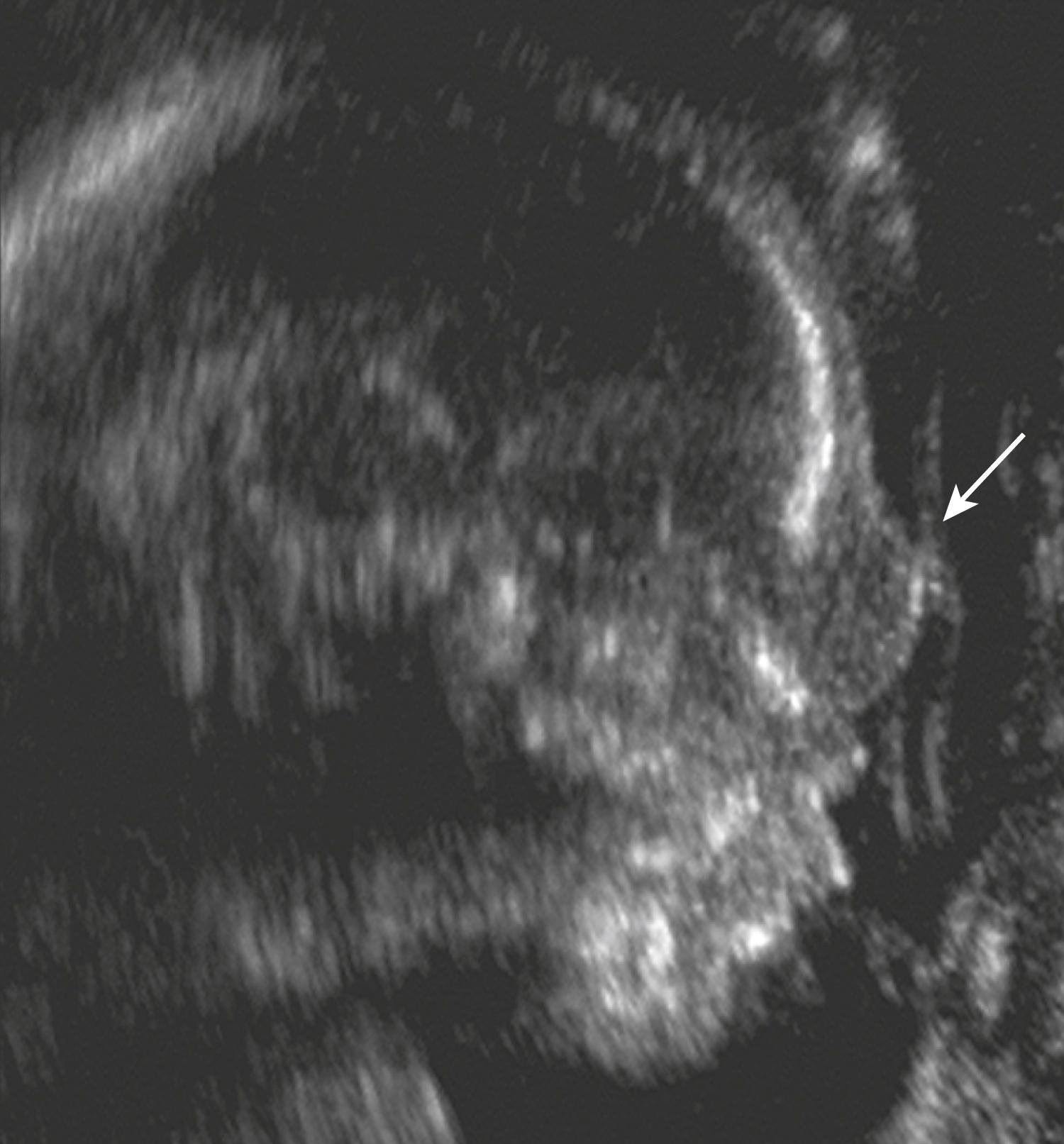 Figure 20.5, Cephalocele: sagittal view.