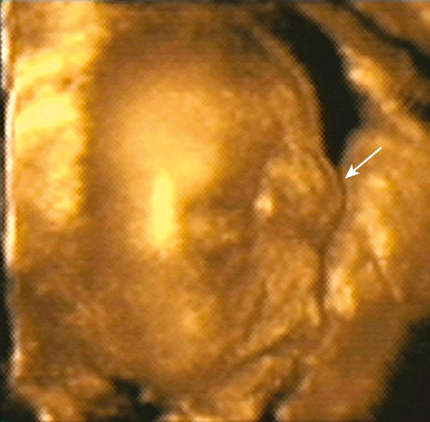 Figure 20.6, Cephalocele: 3D reconstruction (same fetus as in Fig. 20.5).