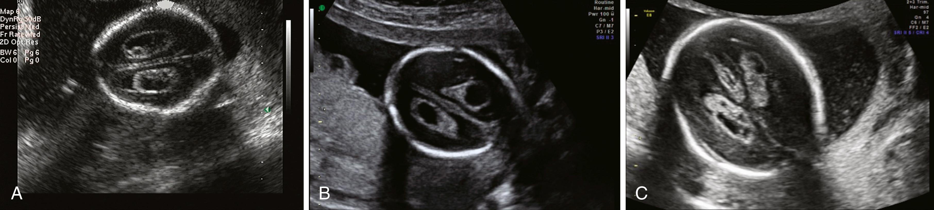 Figure 20.7, Choroid plexus cyst (CPC).