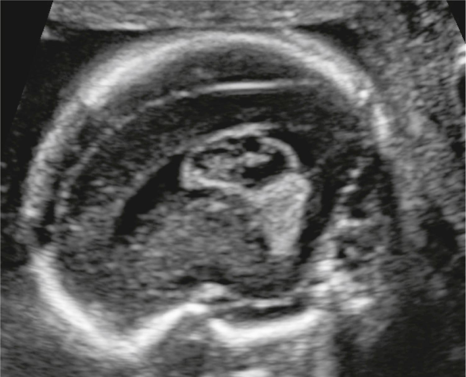 Figure 20.8, Choroid plexus cyst: parasagittal view.