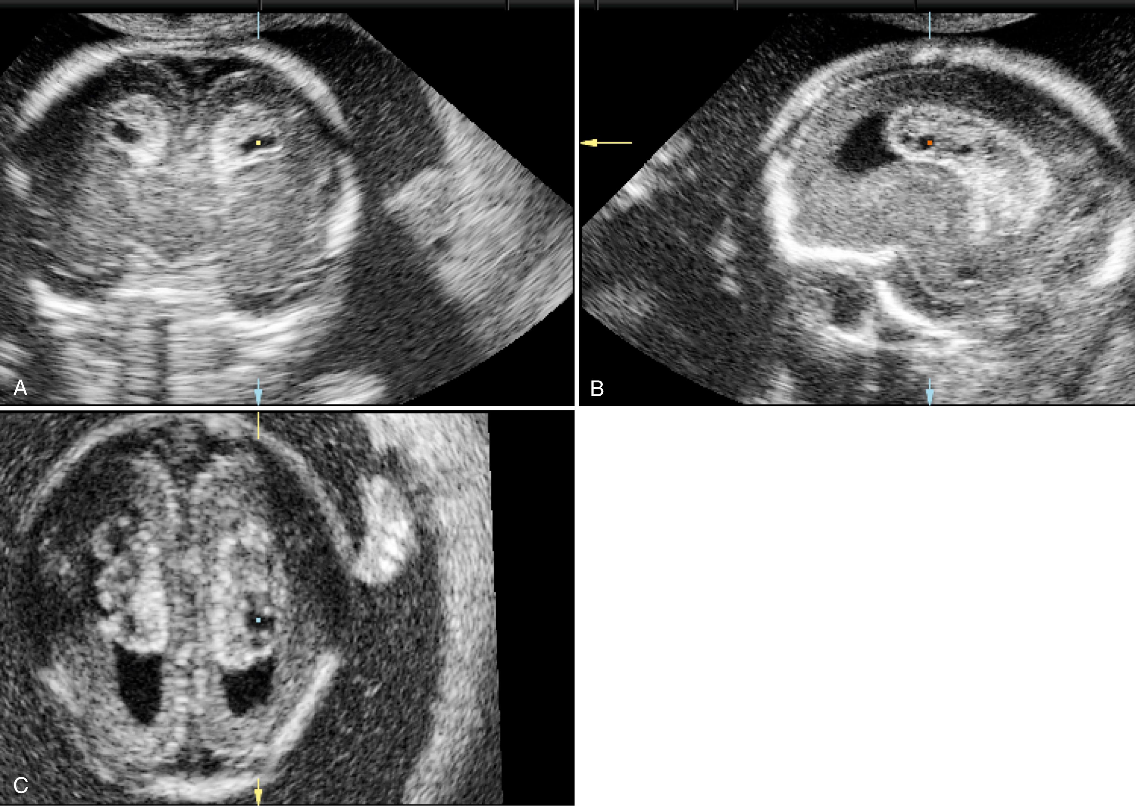 Figure 20.9, Choroid plexus cyst: 3D view.