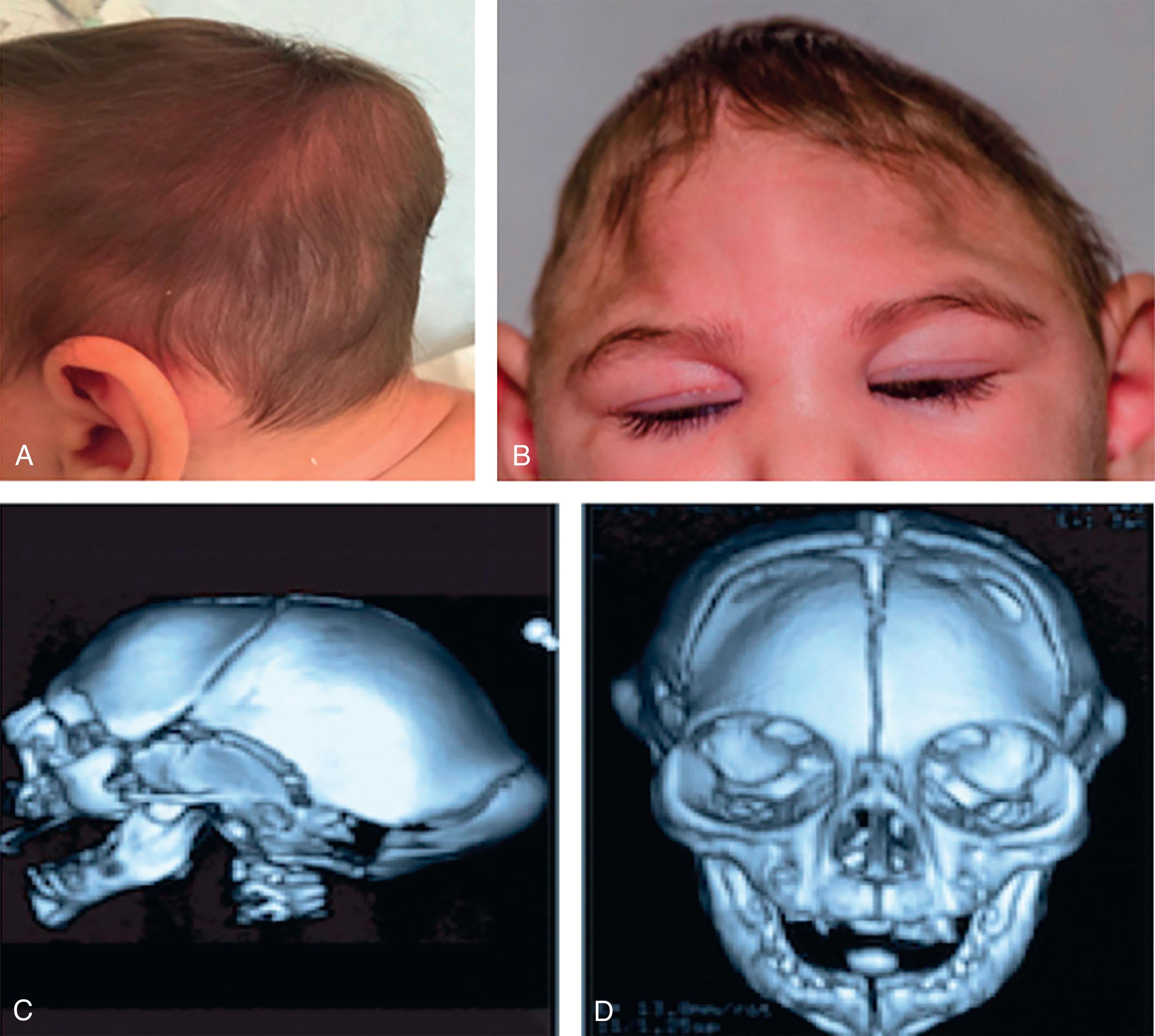 FIGURE 51.1, The occipital prominence is pronounced ( A ) with a very hypoplastic occipital bone on reconstructed computed tomography (CT) image ( C ). A frontal midline bulge is apparent due to significant depression of the lateral aspects on the frontal bone ( B ), which appear more depressed than the parietal bones along with obvious supratemporal depression on CT ( C and D ). The vertical dimension of the cranium is reduced and the parietal vault is narrow ( B and D ).