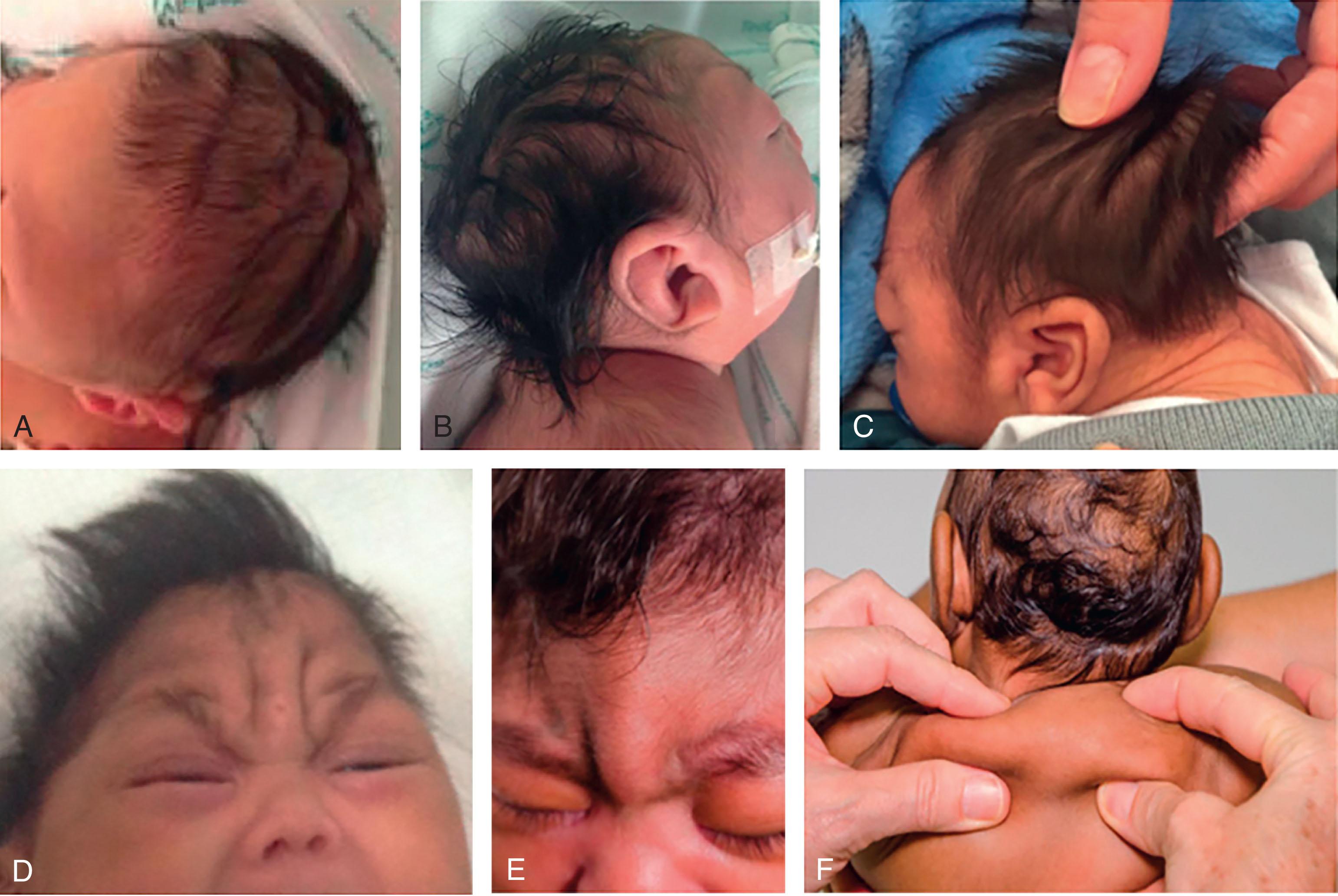 FIGURE 51.2, Redundant skin of the scalp creating transverse folds, that is, “cutis rugata” ( A ), or more cerebriform patterns, that is, “cutis gyrata” ( B ). In other cases, redundant skin is obvious only over the occipital region ( C ) or the glabellar region, where it can create several furrows ( D ) or a bulging single fold, with a crease above the nose, epicanthal folds and full periorbital tissues ( E ). F The excess skin can also be observed in the back, possibly secondary to prolonged fetal immobility and compression.