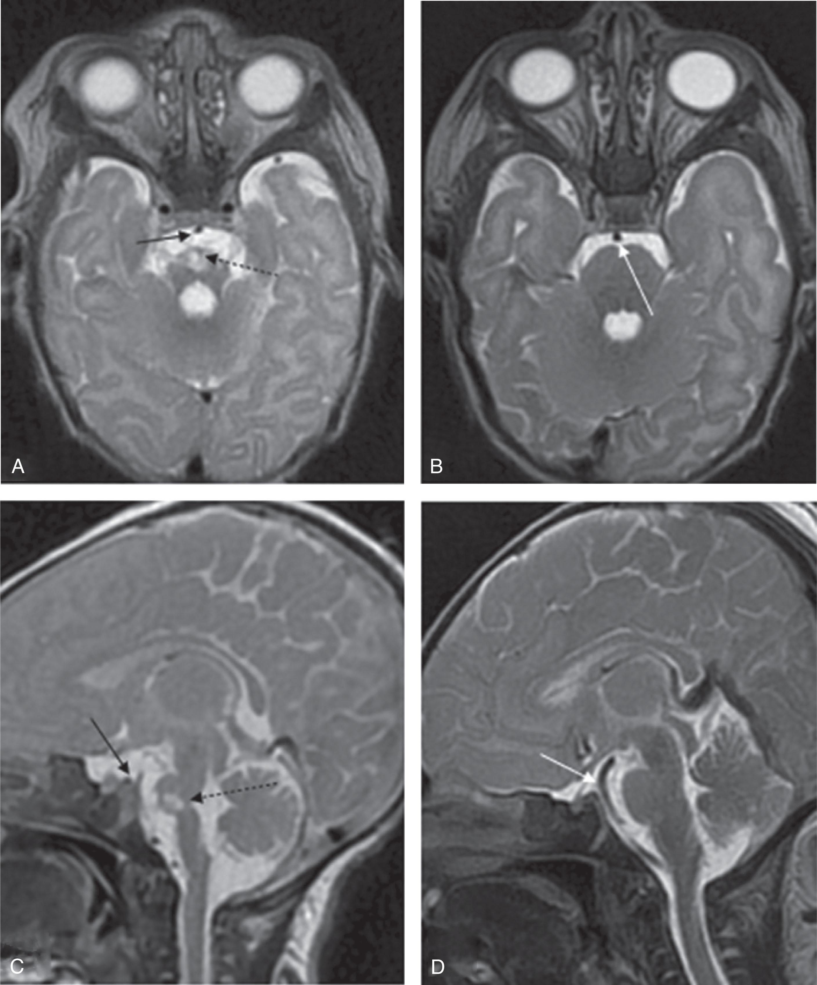 FIGURE. 51.3, Postnatal magnetic resonance image on day 1 of life. T2-weighted sequences (axial ( A ) and midsagittal ( C )) reveal cerebellar and vermian hypoplasia associated with severe brainstem anomalies. A focal hyperintense signal in the pons (dotted arrow) is consistent with the presence of an ischemic/hemorrhagic lesion. On axial ( A ) and sagittal ( C ) T2-weighted sequences, the diameter of the basilar artery appears thin (black arrow) compared with age-matched controls ( B ) and ( D ; white arrow ).