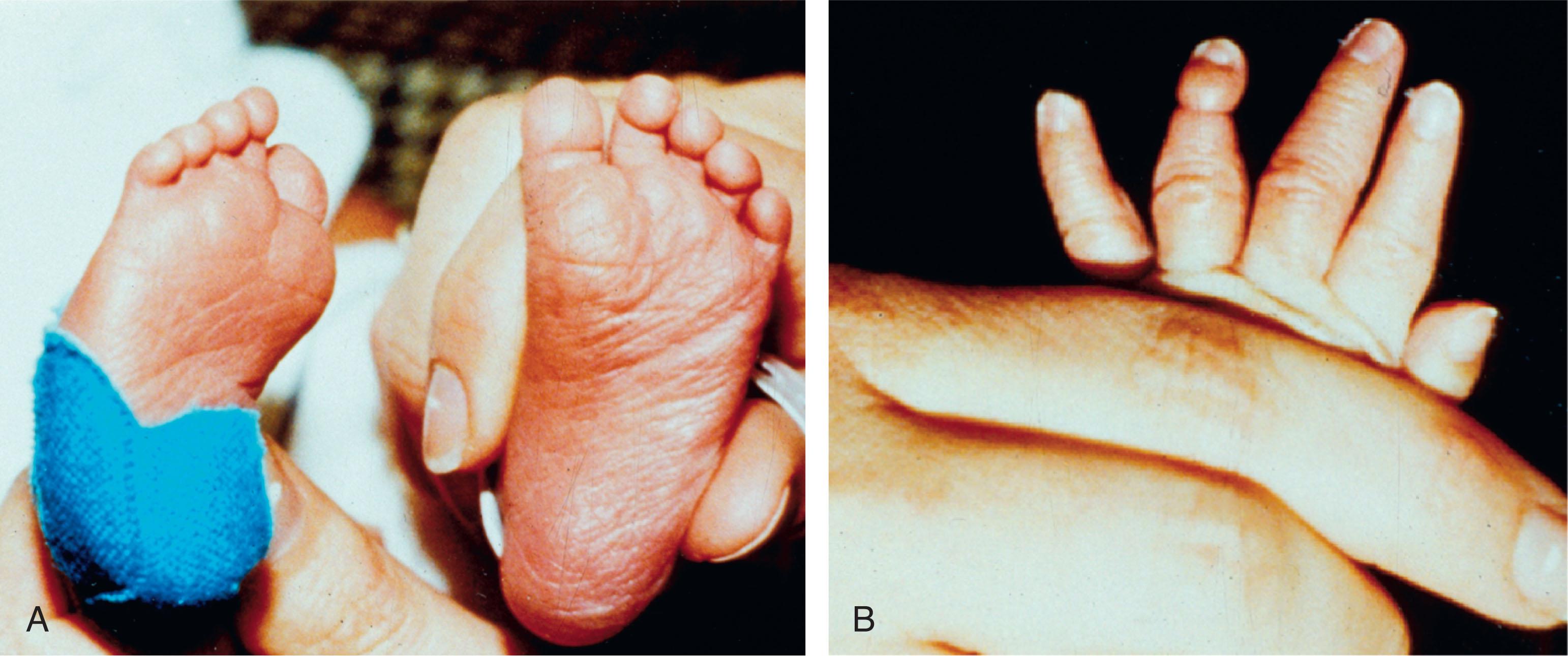 FIGURE 51.4, This rigid equinovarus foot deformity ( A ) was associated with an amniotic band around a finger ( B ) and a history of amniotic fluid leakage at 11 to 12 weeks.