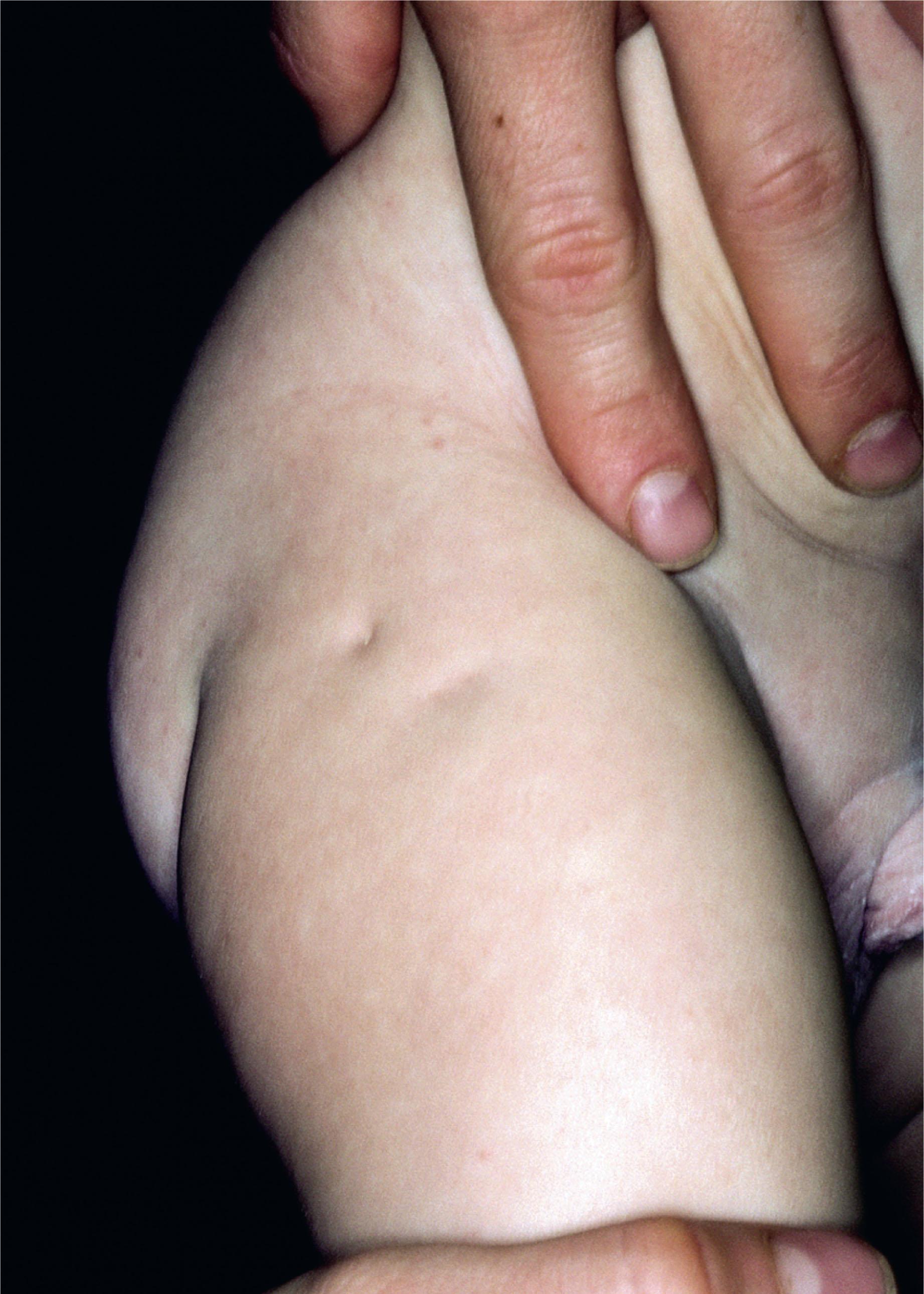 FIGURE 51.5, Amniocentesis puncture needle marks on an infant’s thigh. The parent previously reported that the amniocentesis was carried out without ultrasound guidance and that the needle had to be repositioned several times before eventually drawing bloody amniotic fluid, which yielded a normal male karyotype.