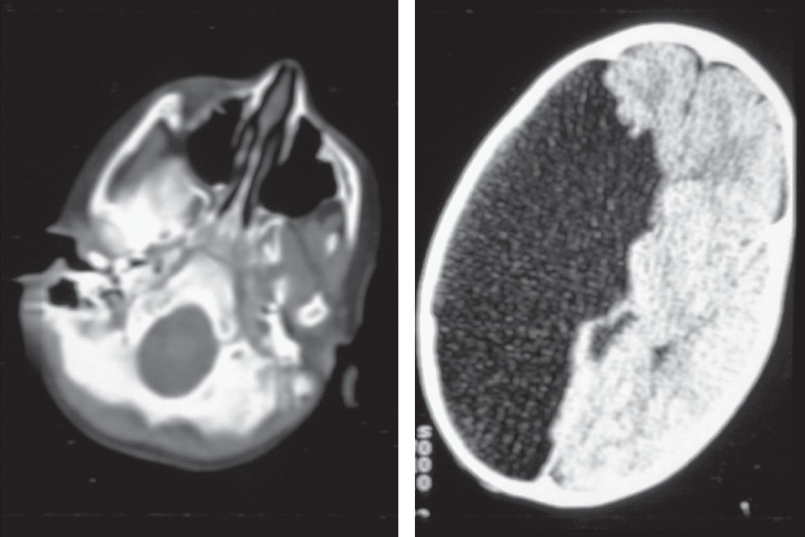 FIGURE 51.6, Amniocentesis-induced porencephaly following amniocentesis done on monozygotic twins during the 16th week without ultrasound guidance. This twin was the first to be tapped after ultrasound was used to identify a fluid pocket and then removed to prep the abdomen. Because the first two needle insertions went through apparent obstructions without yielding fluid, a third insertion was made, and chromosomally normal bloody fluid was obtained. The other twin had a separate amniotic sac and was tapped without incident. The first twin was born with porencephaly resulting from loss of flow in the right carotid artery, causing loss of tissue in the distribution of the right middle and posterior cerebral arteries. An external puncture site was evident just above the right ear, and she had severe intellectual disability with seizures and a left hemiparesis. Magnetic resonance imaging confirmed the porencephaly and demonstrated normal carotid cranial foramina.