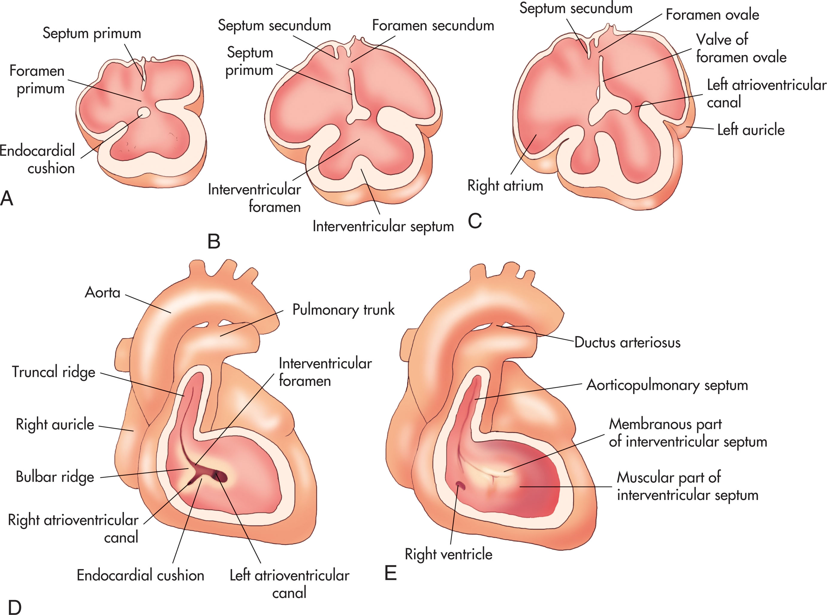 Fig. 35.4, The partitioning of the primitive atrioventricular canal, atrium, and ventricle in the developing heart.