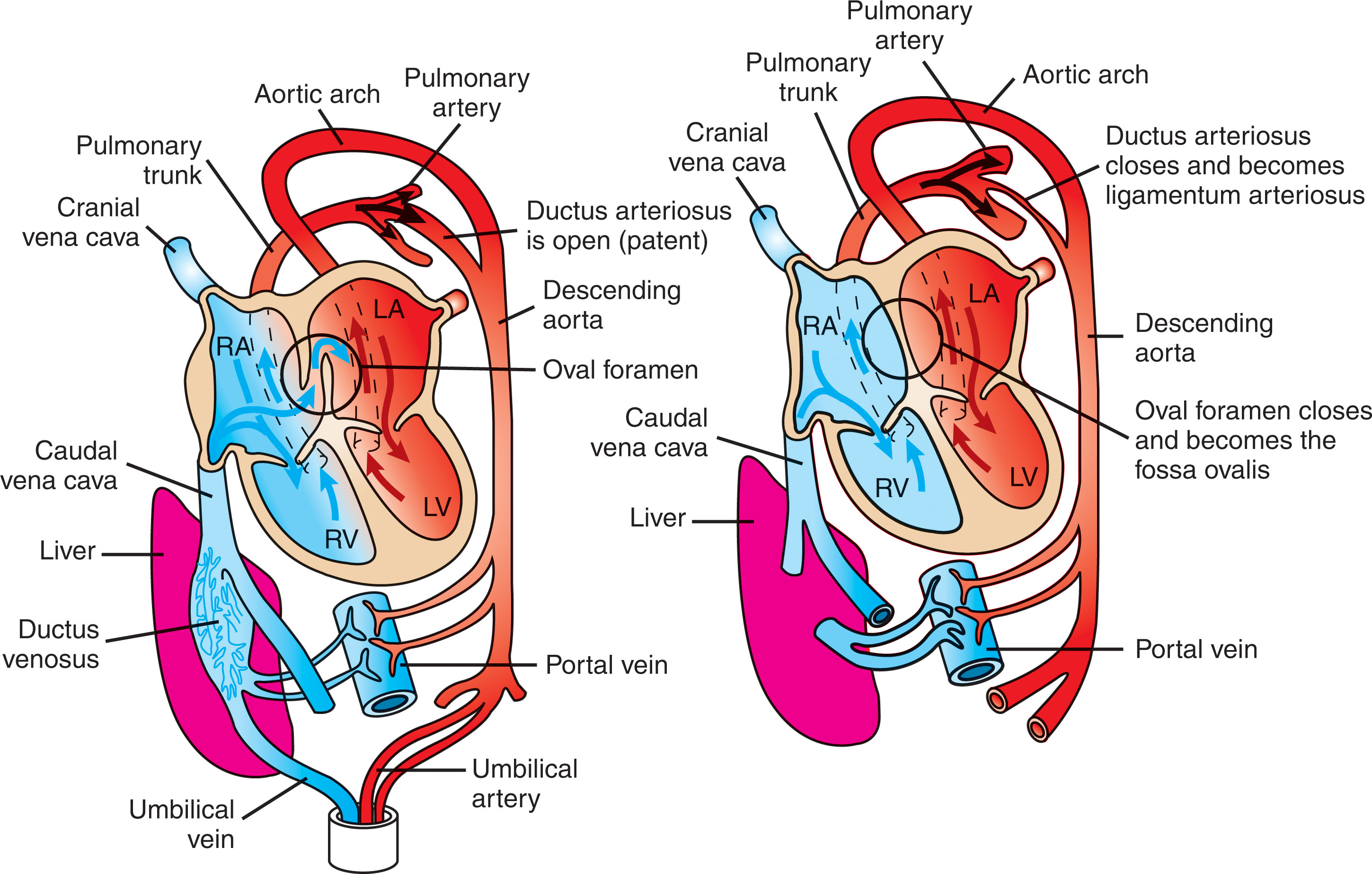 Fig. 35.6, Comparison of the fetal circulation to the neonatal circulation.