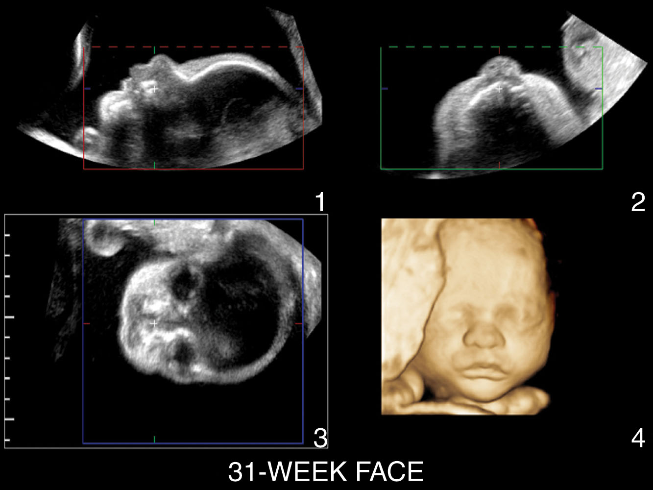 Fig. 59.6, Multiplanar reconstruction through the fetal face displaying three orthogonal planes: (1) sagittal plane, (2) axial plane, (3) coronal plane, and (4) reconstructed facial image.