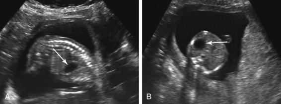 F igure 17-1, Normal stomach: second trimester. Longitudinal (A) and transverse (B) images of the fetal abdomen during the second trimester show a normal-appearing stomach (arrows) in the left upper quadrant.