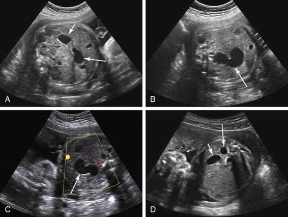 F igure 17-11, Extra bubble in the fetal abdomen: additional etiologies. A to C, Enteric duplication cyst. A, Axial image of the fetal abdomen shows two cystic structures in the upper abdomen, with the stomach (short arrow , image A ) in the left upper quadrant and a teardrop-shaped cystic structure in the mid abdomen (long arrow) in a location similar to that of a duodenal bulb. B, Image of the midline cystic structure in image A at a slightly different level reveals a curved configuration (arrow) . The stomach did not connect with this structure. C, Axial image of the abdomen with power Doppler shows no internal blood flow in the cystic mass (arrow) , excluding a vascular etiology. Postnatal surgical evaluation revealed an enteric duplication cyst. D, Splenic cyst. Axial image of the fetal abdomen in a different patient shows two cystic structures in the left upper quadrant, consisting of a normally located stomach (short arrow) and a splenic cyst posterior to the stomach (long arrow) .
