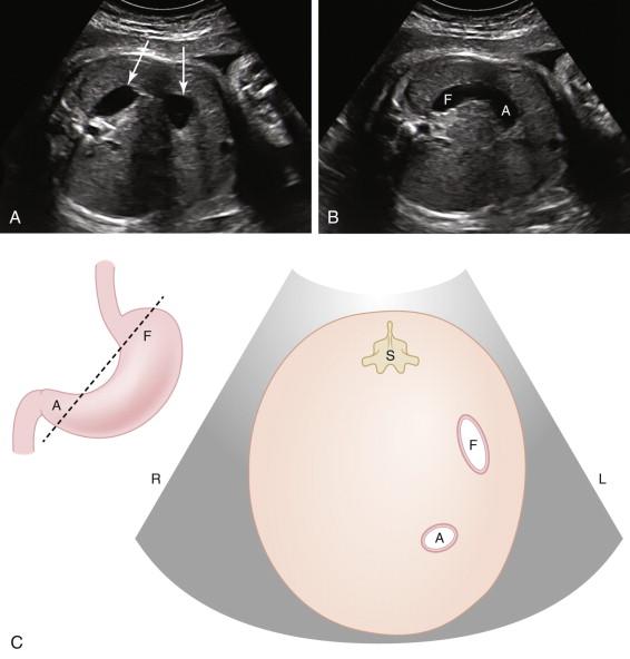 F igure 17-12, Pseudo–double bubble sign. A, Oblique cross section of the fetal abdomen reveals two cystic structures (arrows) suggesting a double-bubble sign. B, Oblique image in a slightly different scan plane than A shows the two cystic structures connecting in a C-shaped configuration consistent with the fundus (F) and antrum (A) of the stomach. Compare this with the double-bubble pattern seen in duodenal atresia (see Figs. 17-9B and 17-10D ), in which the stomach connects to the dilated duodenal bulb through the pylorus. A clue that the apparent double-bubble sign in image A is likely due to normal stomach and not duodenal atresia is that both fluid-filled structures are located to the left of midline, whereas a dilated duodenal bulb is typically found slightly to the right of midline. C, Schematic representation of the pseudo–double-bubble sign demonstrates that the scan plane ( dotted line , left drawing) extends through both the fundus and antrum of the stomach, due to curved gastric configuration. Corresponding cross section of the abdomen (right drawing), similar to ultrasound image in Fig. 17-12A except that the spine is at the top of the image in the drawing and at the left side of the ultrasound image, demonstrates two fluid structures in the left abdomen secondary to gastric fundus and antrum. Appearance is not consistent with double-bubble sign because it is due to normal curvature of the stomach, not a dilated duodenal bulb. A, Gastric antrum; F, gastric fundus; L, left; R, right; S, spine.