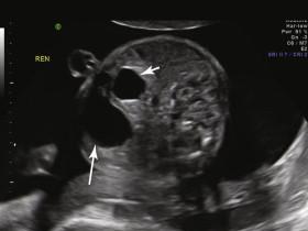 e -F igure 17-1, Axial image of fetal abdomen at level of double bubble sign in similar scan plane to Video 17-2 reveals a large stomach (long arrow) in left upper quadrant and large duodenal bulb to the right of midline (short arrow). See also e-Fig. 17-2 .