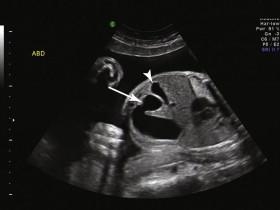 e -F igure 17-2, Oblique image of fetal abdomen in same fetus demonstrates the connection between the stomach and duodenal bulb (arrow), also seen in an axial scan plane on the video clip. The fetal gallbladder (arrowhead) is visualized in the right upper quadrant. See also Video 17-2 and e-Fig. 17-1 .
