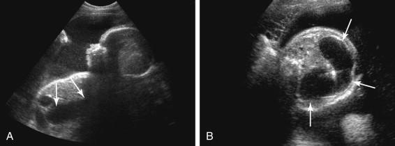 F igure 17-13, Concurrent esophageal atresia and duodenal atresia. A, Left parasagittal image of the fetus shows a prominent dilated fluid-filled structure coursing from the thorax to the upper abdomen (arrows) corresponding to dilatation of the portion of the esophagus and stomach located distal to the esophageal atresia and proximal to the duodenal atresia. B, Oblique image of the abdomen shows a large, closed C-shaped loop of dilated fluid-filled bowel (arrows) comprising the esophagus distal to the atretic esophageal segment and the stomach and duodenum proximal to the atretic duodenal segment.