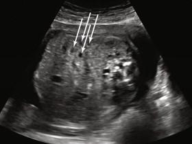 F igure 17-14, Axial image of the fetal abdomen at 27 weeks shows several tiny normal loops of small bowel containing minimal fluid (arrows) .