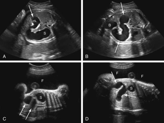 F igure 17-15, Jejunal atresia: examples in two fetuses. A and B, Axial (A) and coronal (B) images of the abdomen show dilated stomach (S) and jejunum (arrows) in a fetus with jejunal atresia. Despite the bowel obstruction, there is no evidence of polyhydramnios. B, Bladder. C and D, Left parasagittal (C) and coronal (D) images of the abdomen in a different fetus with jejunal atresia demonstrate a prominent stomach (S) and dilated proximal jejunum (arrows) . There is also polyhydramnios (F).