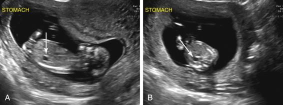 F igure 17-2, Normal stomach: first trimester. Longitudinal image of an embryo (A) and transverse image of the upper abdomen (B) at a gestational age of 11 weeks 6 days show a normal-appearing stomach (arrows) in the left upper abdomen.